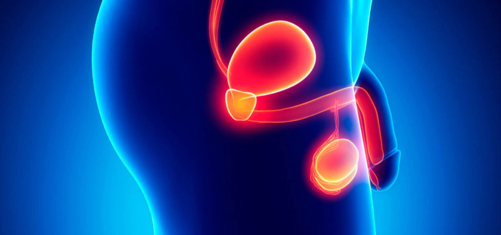 cancer de prostata