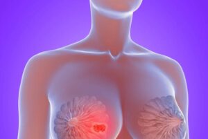 12 Síntomas del cáncer de mama