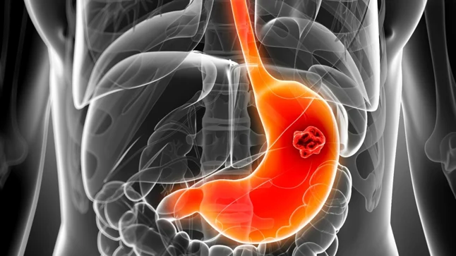 cáncer de estómago