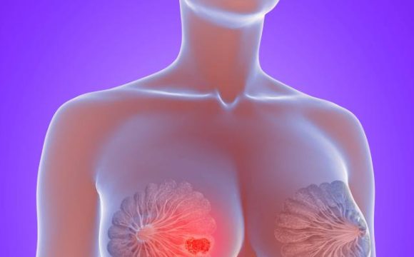 12 Síntomas del cáncer de mama
