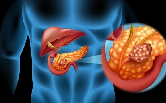 Cáncer de páncreas