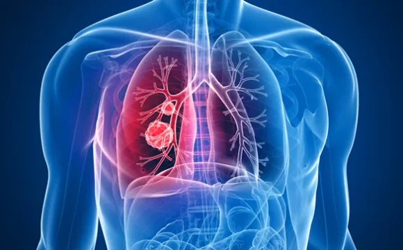 cáncer de pulmón